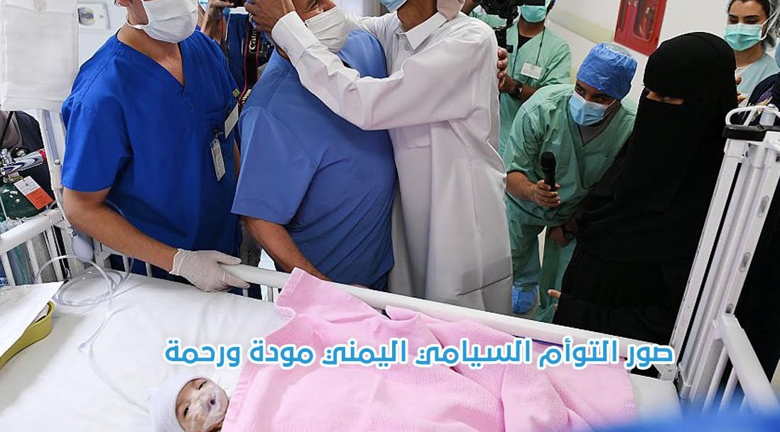 البوكس نيوز – صور التوأم السيامي اليمني مودة ورحمة قبل وبعد الفصل