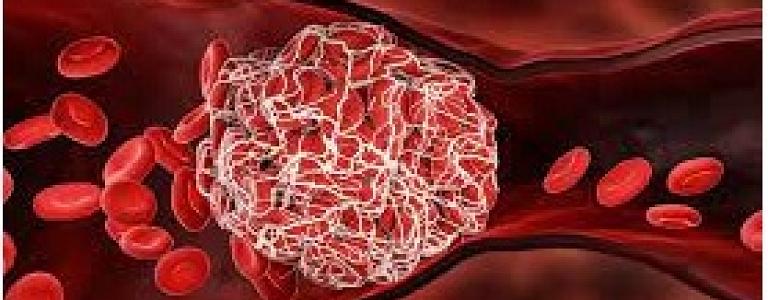 البوكس نيوز – أهم علامات و أعراض الإصابة بجلطات الدم