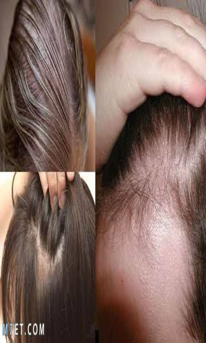 فوائد الروزماري والقرنفل في أنبات الشعر – البوكس نيوز