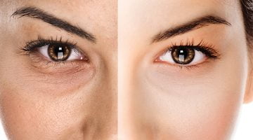 كيفية علاج الهالات السوداء تحت العين؟ وأسباب ظهورها – البوكس نيوز